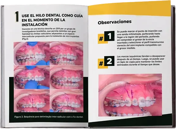 Guía de Biomecánica Avanzada con Mini-Implantes