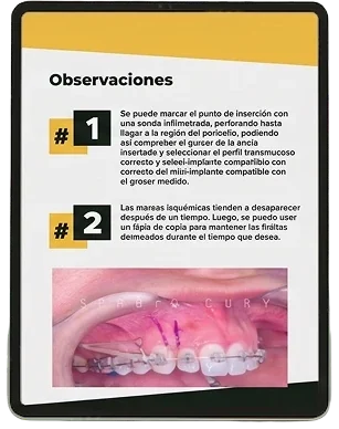 Protocolo de Higiene Peri-implantar
